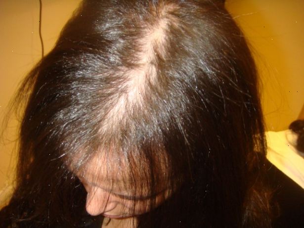 Hur du handskas med kvinnligt håravfall. Gå online och hitta en källa för en anti sebolytic hårbotten rengöringsmedel och använda den regelbundet.