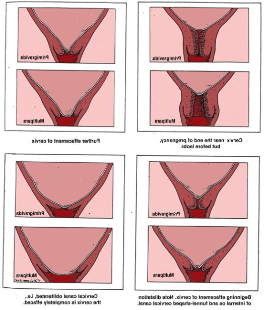 Hur att vidga livmoderhalsen. Titta efter tecken på cervix dilaterad om du är nära slutet av graviditeten.