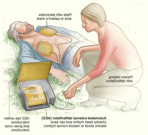 Hur man använder en defibrillator. Applicera dynor till offrets nakna bröst som visas.