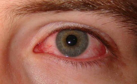 Hur man behandlar rosa ögat (konjunktivit). Identifiera symptomen.