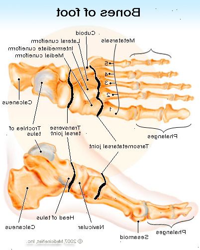 Hur man behandlar en bruten fot. Erkänn ett brutet ben av följande symtom.