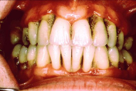 Hur man behandlar tandlossning. Besök din tandläkare, som kommer att göra en djuprengöring av dina tänder och tandkött.