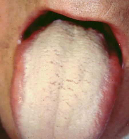 Hur bli av med vit tunga. Börjar på själva basen av tungan, placera tungan renare spola mot tungan yta och gör långsamma svepande drag från back-to-front.
