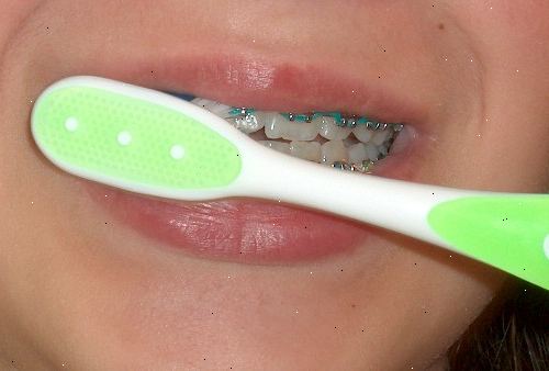 Hur man borsta tänderna med hängslen på. Få en rengöring med din tandhygienist.