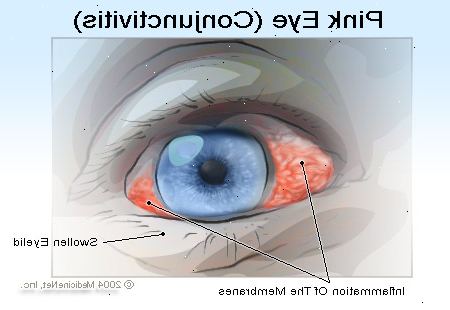 Hur kan man hantera med rosa öga. Utvärdera svårighetsgraden av ditt tillstånd.