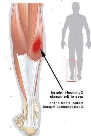 Hur man diagnostiserar en sönderriven vadmuskeln. Inse att vadmuskeln faktiskt består av två muskler som är kopplade till hälsenan på baksidan av knäet.