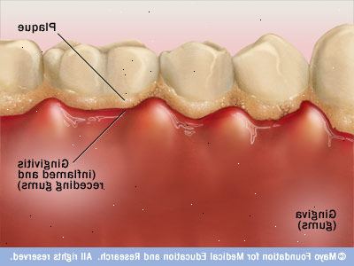Hur kan man förhindra tandköttsinflammation. Gå och se dina eller tandhygienist varje halvår.