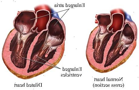 Hur man kan behandla ett förstorat hjärta. Ta angiotensin-converting enzyme (ACE)-hämmare, som ordinerats.