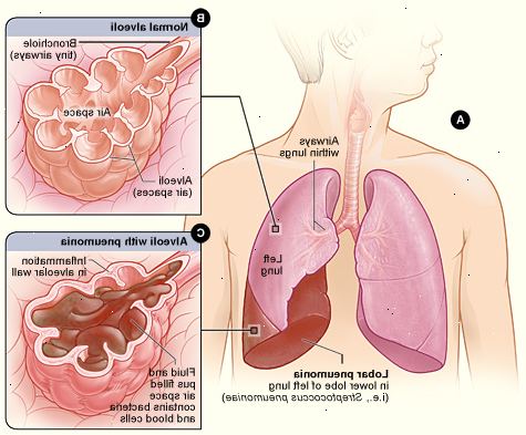 Hur man ska behandla lunginflammation. Boka tid med din läkare för att få rätt diagnos och nödvändig medicin för lunginflammation.