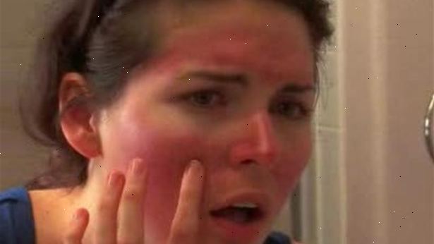 Hur man behandlar en solbränna. Ta en over-the-counter smärtstillande.