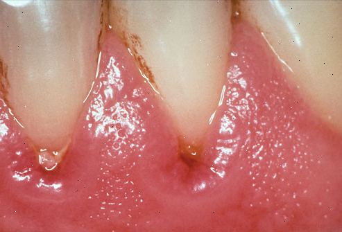 Hur att stoppa blödande tandkött, gingivit, parodontit. Inse att detta är ett sår på kroppen - samma som en infekterad snitt på armen.