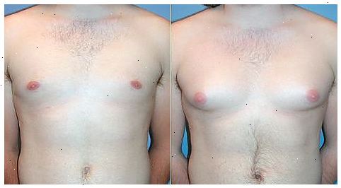Hur man kan minska manliga bröst. Gynekomasti är en ovanlig hormonell obalans hos vuxna och unga män som orsakar bröstvävnad att utvecklas på ett sätt som liknar bröstvävnad hos kvinnor.