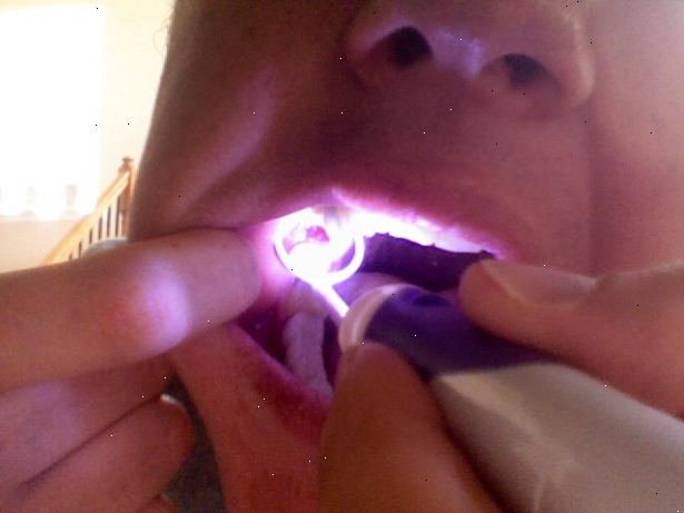 Hur man behandlar en torr socket. Återgå till din muntliga kirurg eller tandläkare.