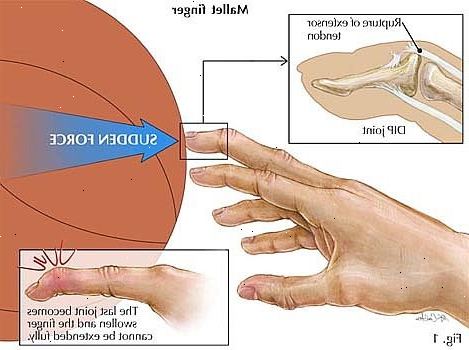 Hur man kan behandla en fastnat finger. Se till att skadan inte har resulterat i en benfraktur.