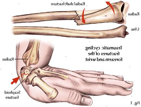 Hur man ger första hjälpen för ett brutet ben. Immobilisera skadade området, men försök inte att flytta den till sitt ursprungliga läge, såvida cirkulation är avskuren (behandlas i ett senare steg).